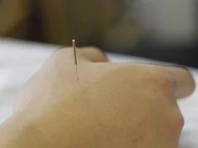 Intramuscular Stimulation Technique Burlington