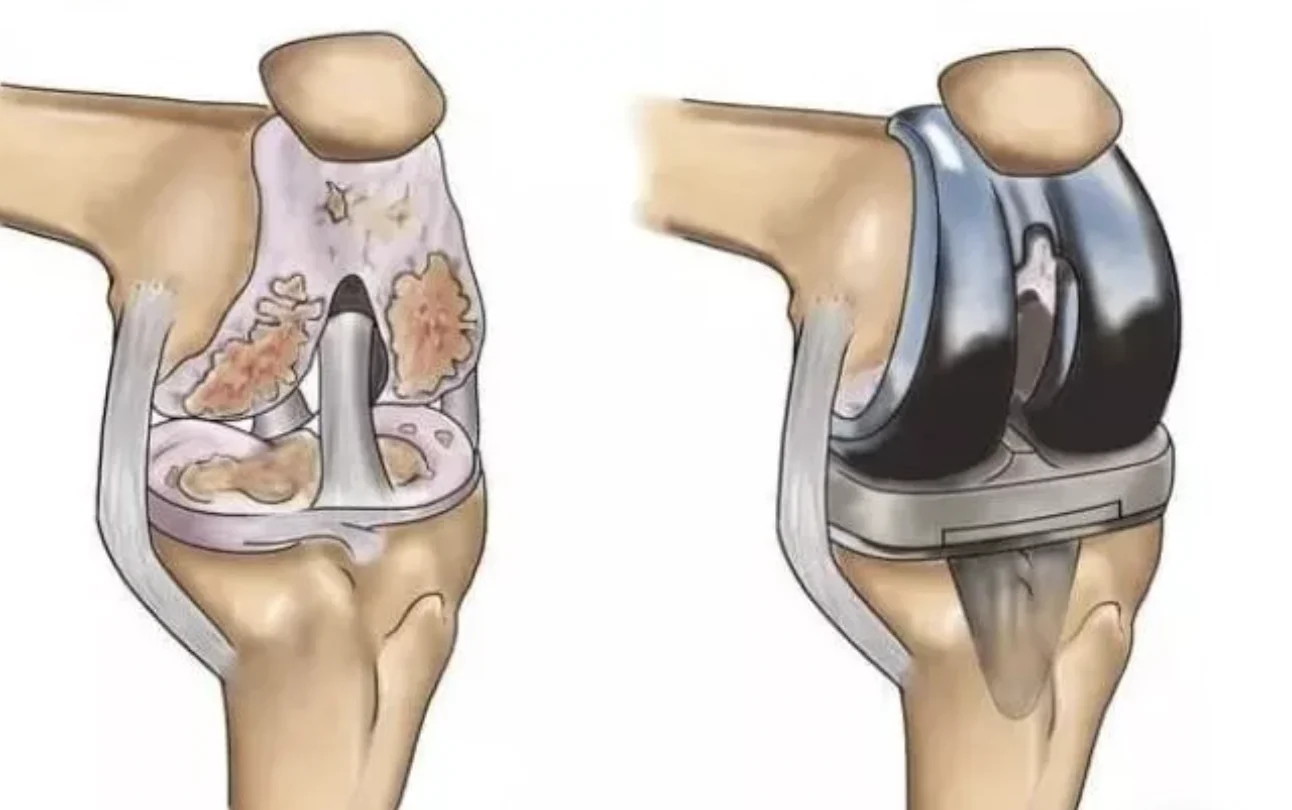 Knee Replacement Recovery: The Essential Role of Physiotherapy at Sheddon