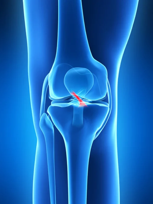 ACL Recovery: A Complete Guide to Rehabilitation and Return to Sport