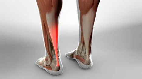 Tendinitis vs. Tendinopathy: Understanding Your Achilles at Sheddon