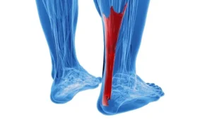 Achilles tendon anatomy and injury risk Burlington